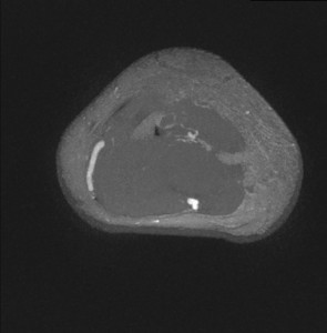 MRI images of a volunteers blood vessels - 1