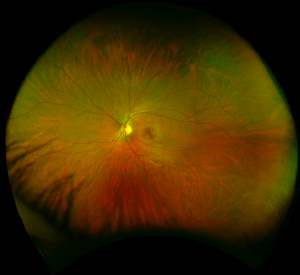 Optos - Healthy Retina